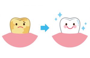 気になる『歯の黄ばみ』原因と対策を解説（歯のホワイトニング）